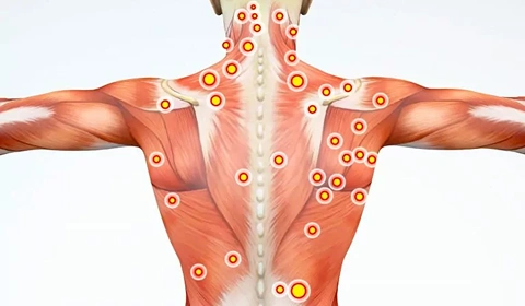 Illustration showing back muscle trigger points.